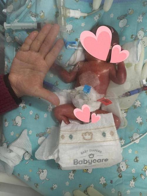 2025新澳门精准正版图库和台早产女婴术后瘫痪与早产儿手术后度过危险期